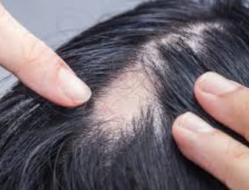 Alopecia: stora, cause e nuove prospettive